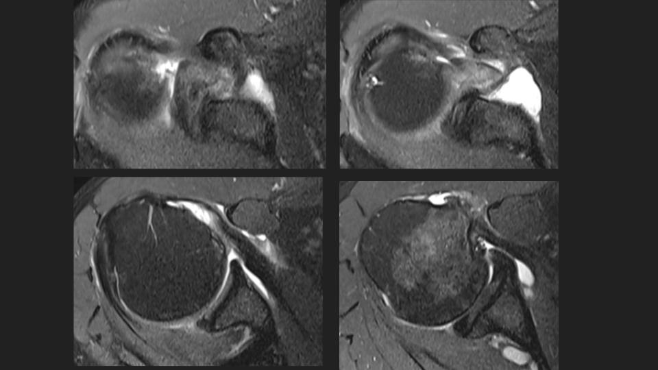 Figure 1 for case tendon of long head of biceps brachii ( RID1944 )